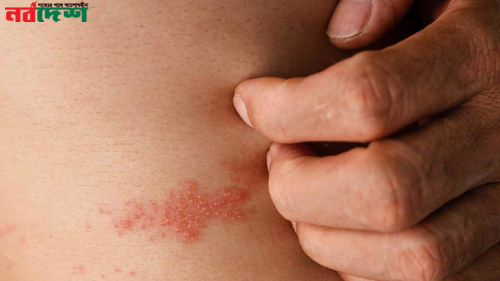 বসন্ত আসার আগেই পক্সের মতো ফোস্কা দেখা দিচ্ছে গায়ে? হারপিস জস্টারে আক্রান্ত নন তো?