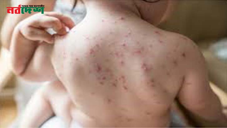 হামে আক্রান্ত হয়ে রাজধানীর এক হাসপাতালেই ২২ শিশুর মৃত্যু